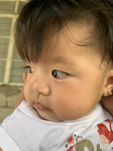 Ano po kaya itong nasa mata ni baby