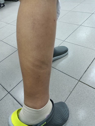 ขาบวม