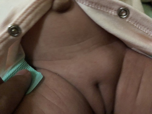 มีก้อนบริเวณหัวหน่าว