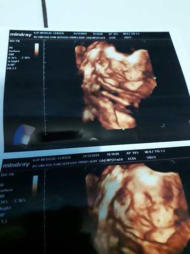 galau bunda di37 minggu dede bayinya msih sungsang,