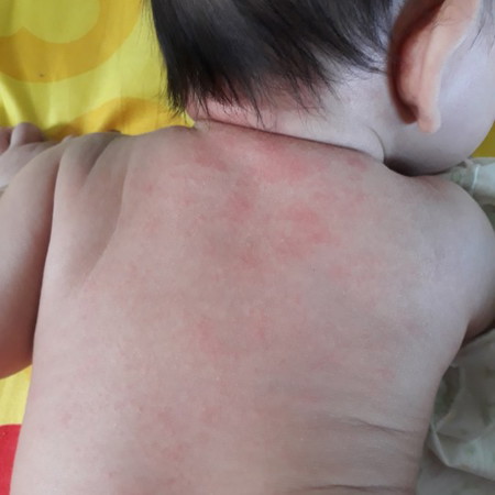 น้องเป็นผื่นที่หลัง