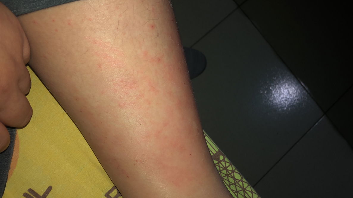 gatal2 hamil 38 minggu