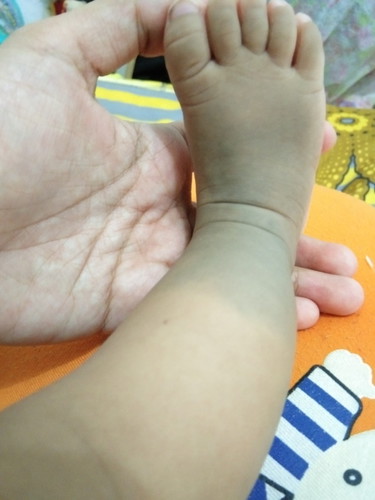 bercak biru pada bayi