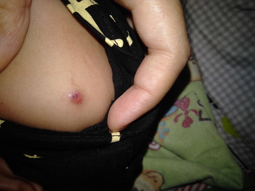 bekas imunisasi