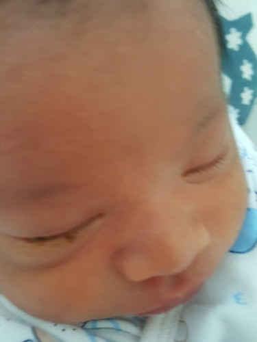 น้องคลอด12/7/19. น้องมีขี้ตาเยอะมาก ลืมตาลำบาก