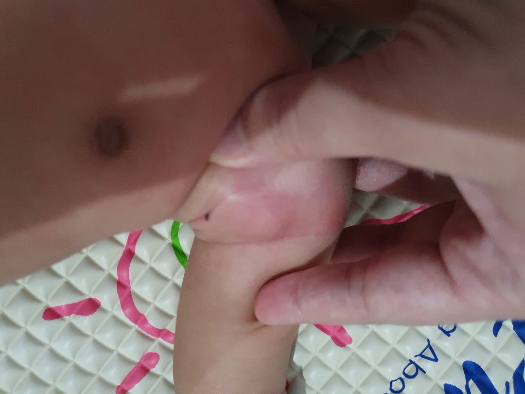 ลูกมีตุ่มขึ้นใต้รักแร้ เกิดจากอะไรคะ