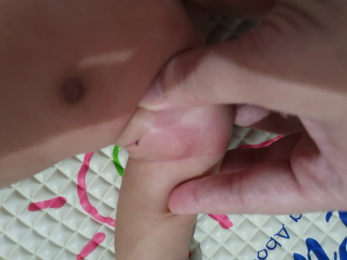 ลูกมีตุ่มขึ้นใต้รักแร้ เกิดจากอะไรคะ