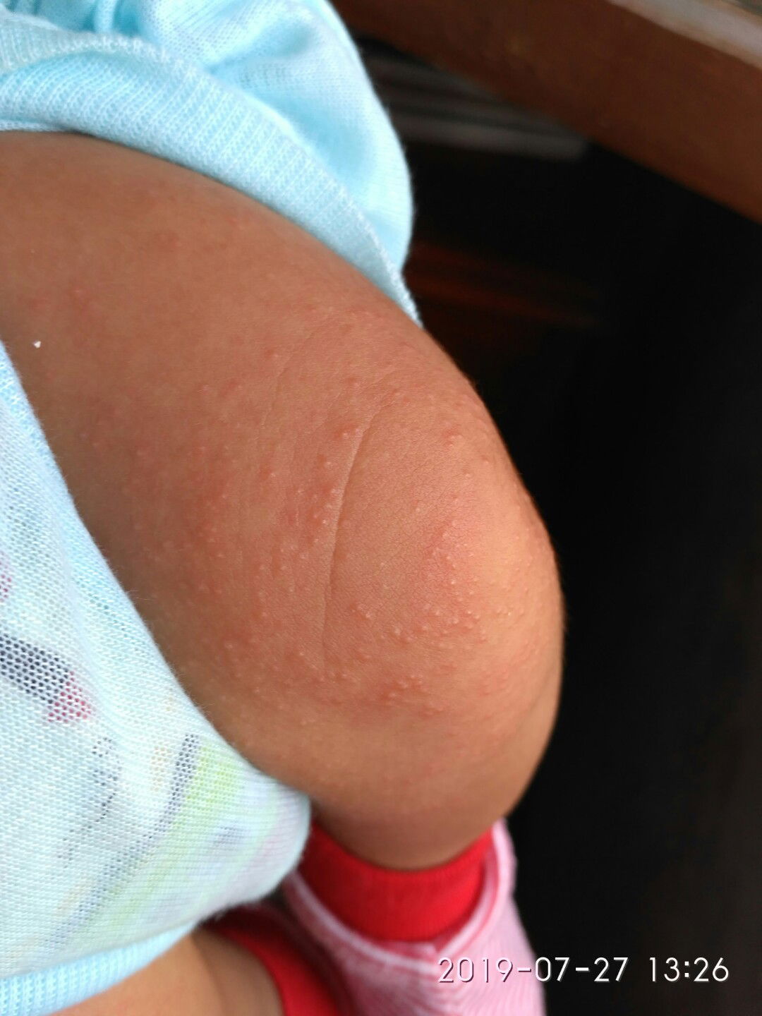 Ruam Bayi *biyah/biduren*