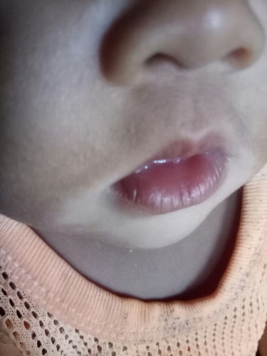 ใบหน้าลอก