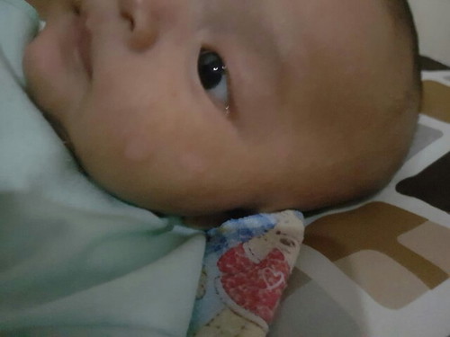 kulit pipi bayi kering