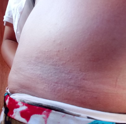 Rashes.