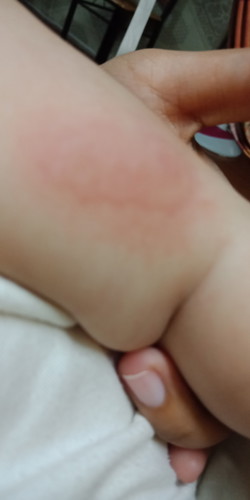 Mosquito bite??