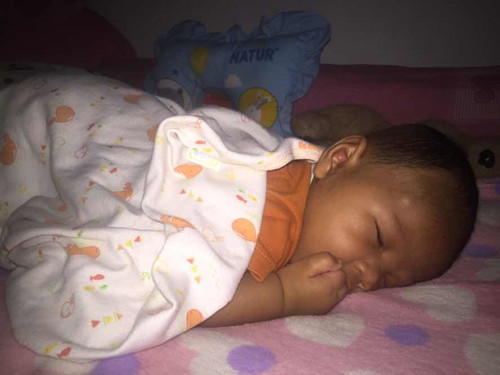 กระดูกโนที่ขมับ