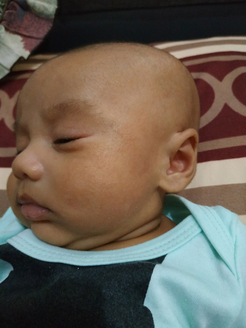 Pipi Kering Kemerahan