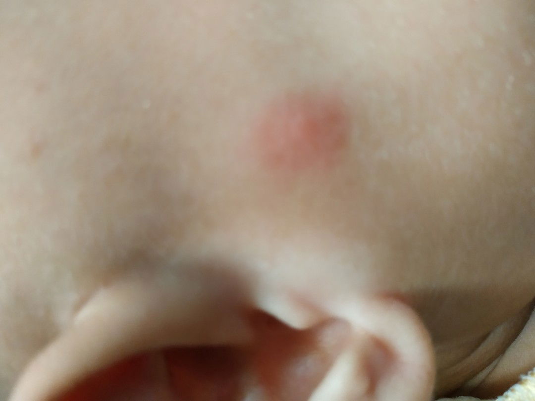 Obat Nyamuk Yang Aman Buat Bayi Apa Ya