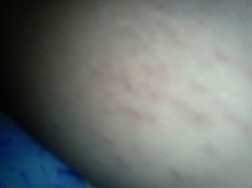 VARICOUS VEIN SA BUTT AREA