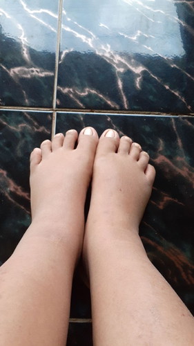 kaki bengkak