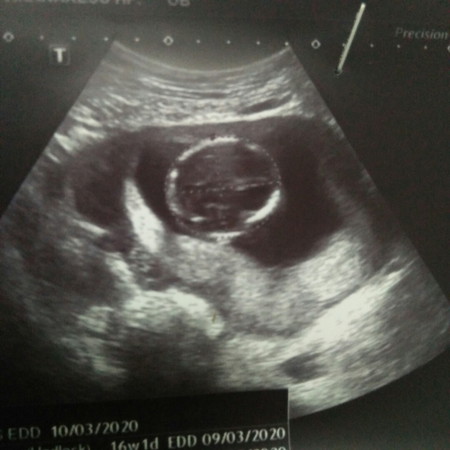 สอบถามเพศค่ะ อายุครรภ์16สัปดาห์