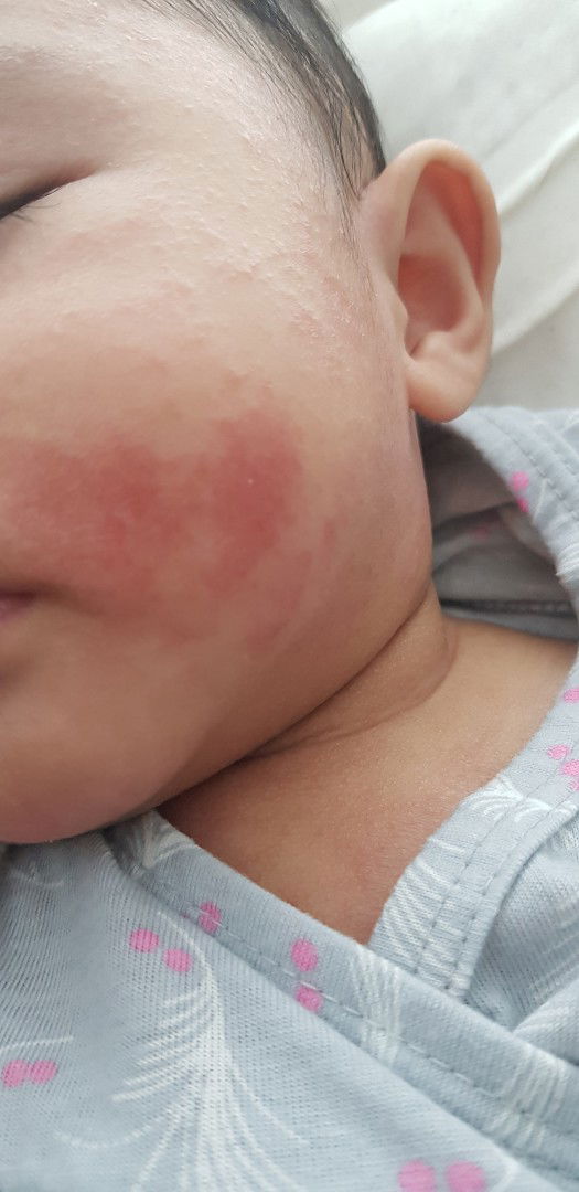 rash or eczema?