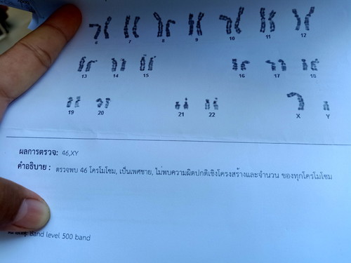 ผลเคาะน้ำคร่ำ
