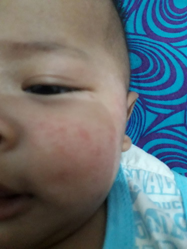 Pipi bayi merah-merah (usia 4 bln)
