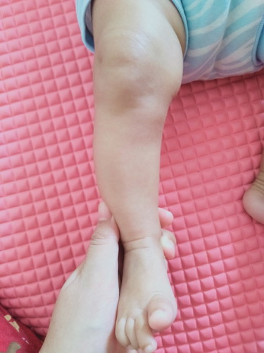 Bentuk kaki bayi