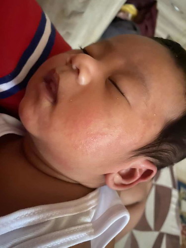 RASHES :(( SANA MASAGOT