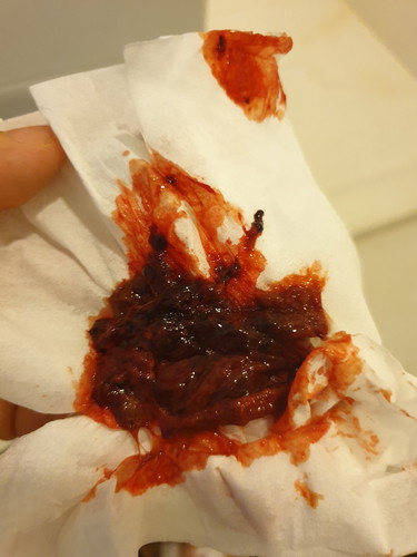 ตกเลือดหรือรกเก่าที่ค้างๆ