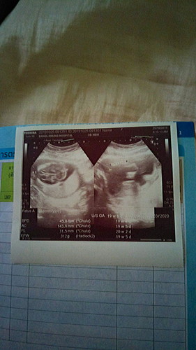 ไป อัลตร้าซาวด์มาค่ะหมอไม่บอกอะไรเกี่ยวกับใบซาว