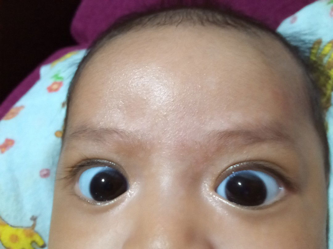 bercak putih spt panu