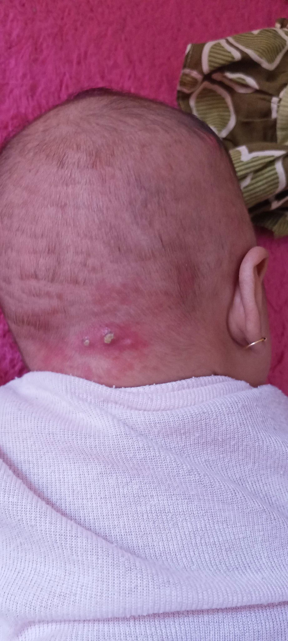 kepala bayi 2bm bln bentol dan bernanah