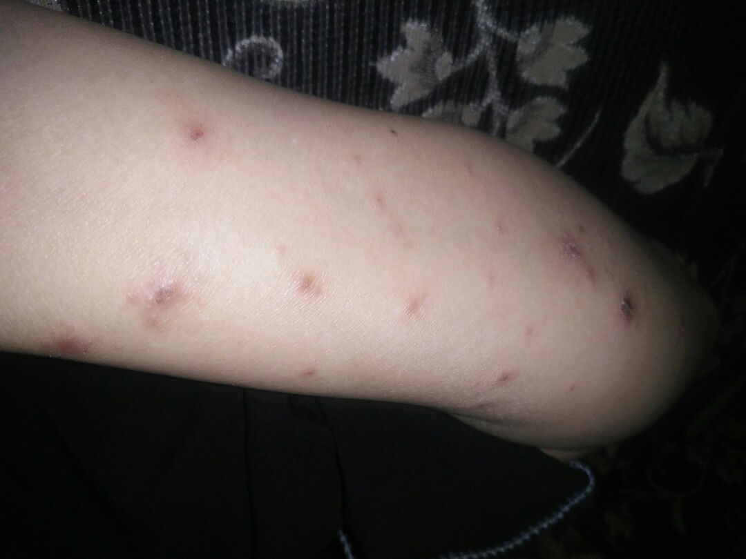 gatal di sekujur badan.