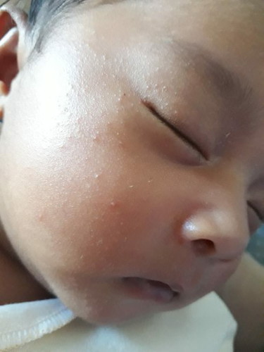 Bintik Merah Bayi