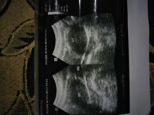 Hasil USG