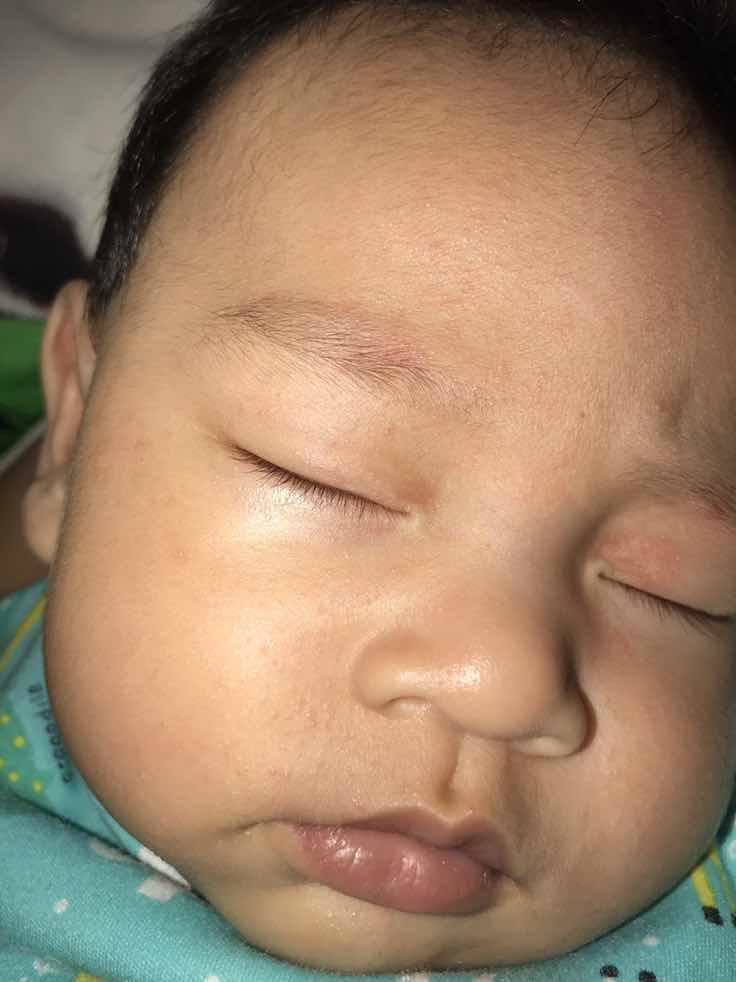 Menghilangkan brintis