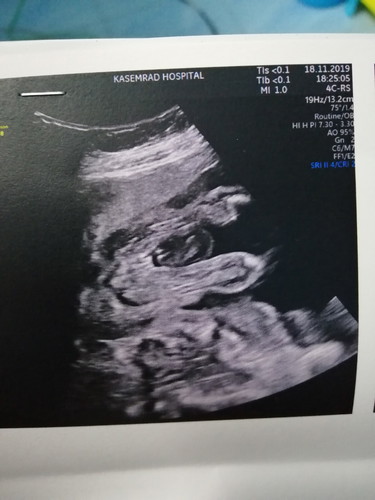 เพศลูก