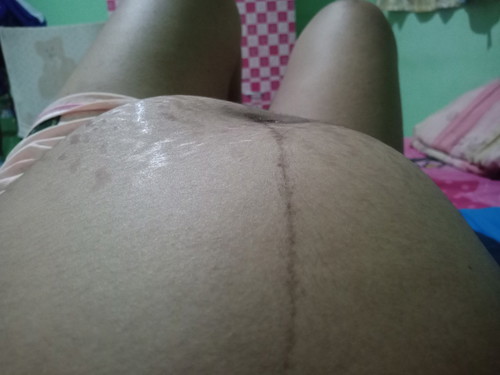 ลูกโก่งตัว