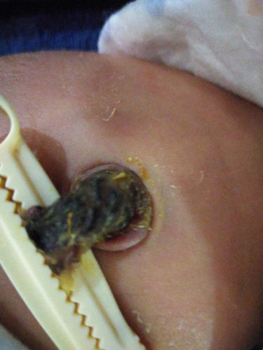 สะดือในเด็กทารกแรกเกิด