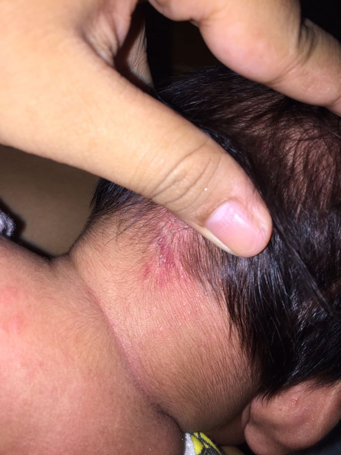 แบบนี้ผดร้อนหรือน้องเป็นอะไรครับ???