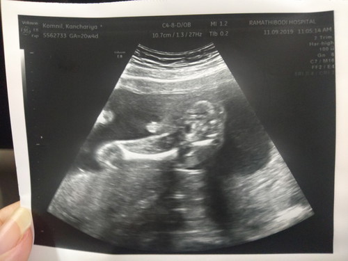 ผลอันตราซาวด์