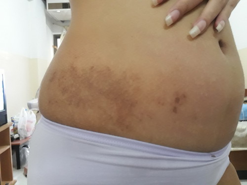 แม่ท้องคนไหนมีผื่นที่ท้อง แล้วเป็นปื้นๆทิ้งรอยดำแบบนี้มั้ยคะ