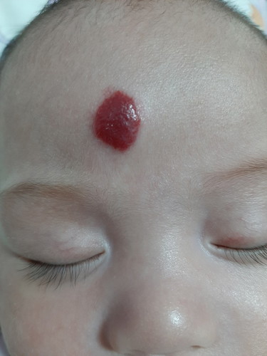 hemangioma