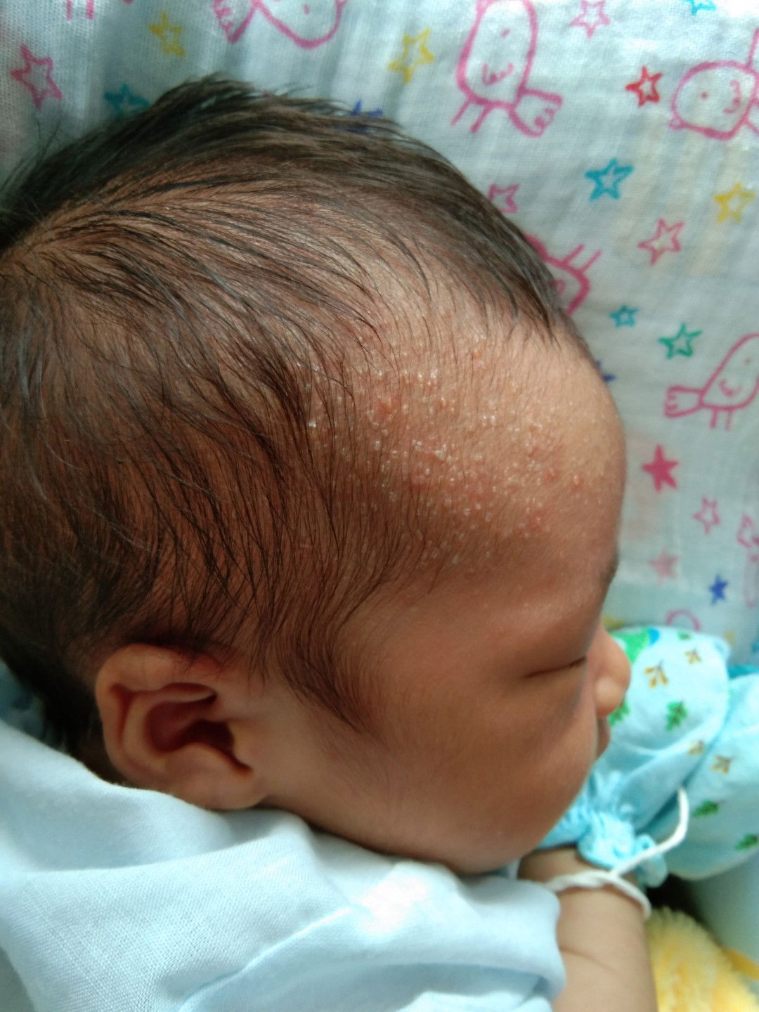 แบบนี้คือผดร้อนไช่มั้ยคะ ?