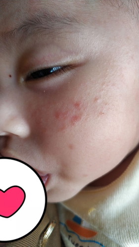 ruam pipi