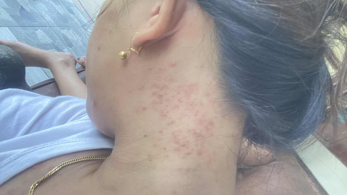 Semenjak hamil badan penuh bintik” seperti jerawat