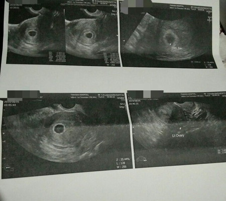 ซาวด์ครั้งที่2สรุปท้องลม
