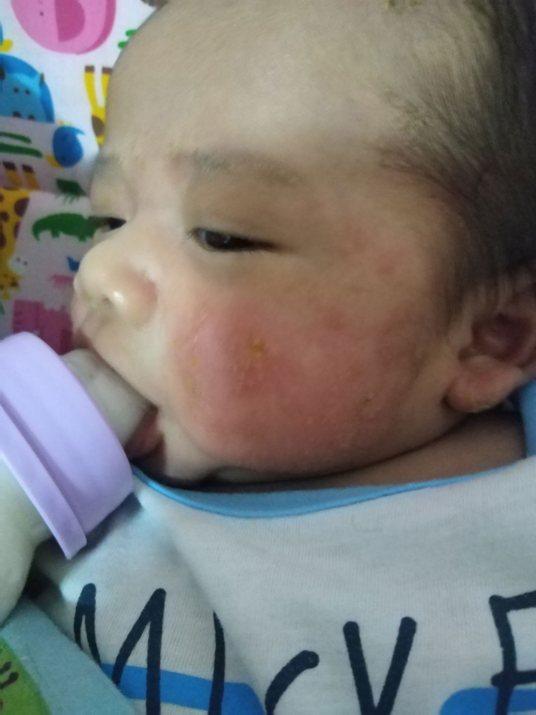 ผื่นที่แก้มใช้อะไรทาถึงหาย