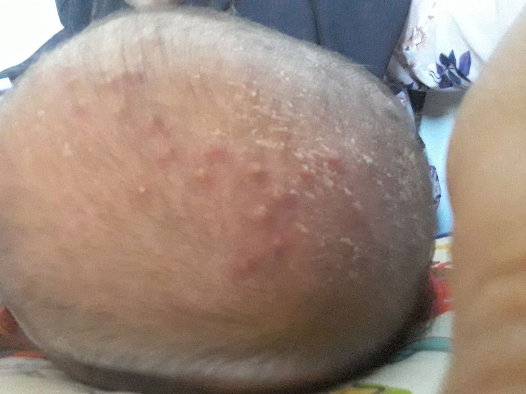 bisul-bisul kecil di kepala.