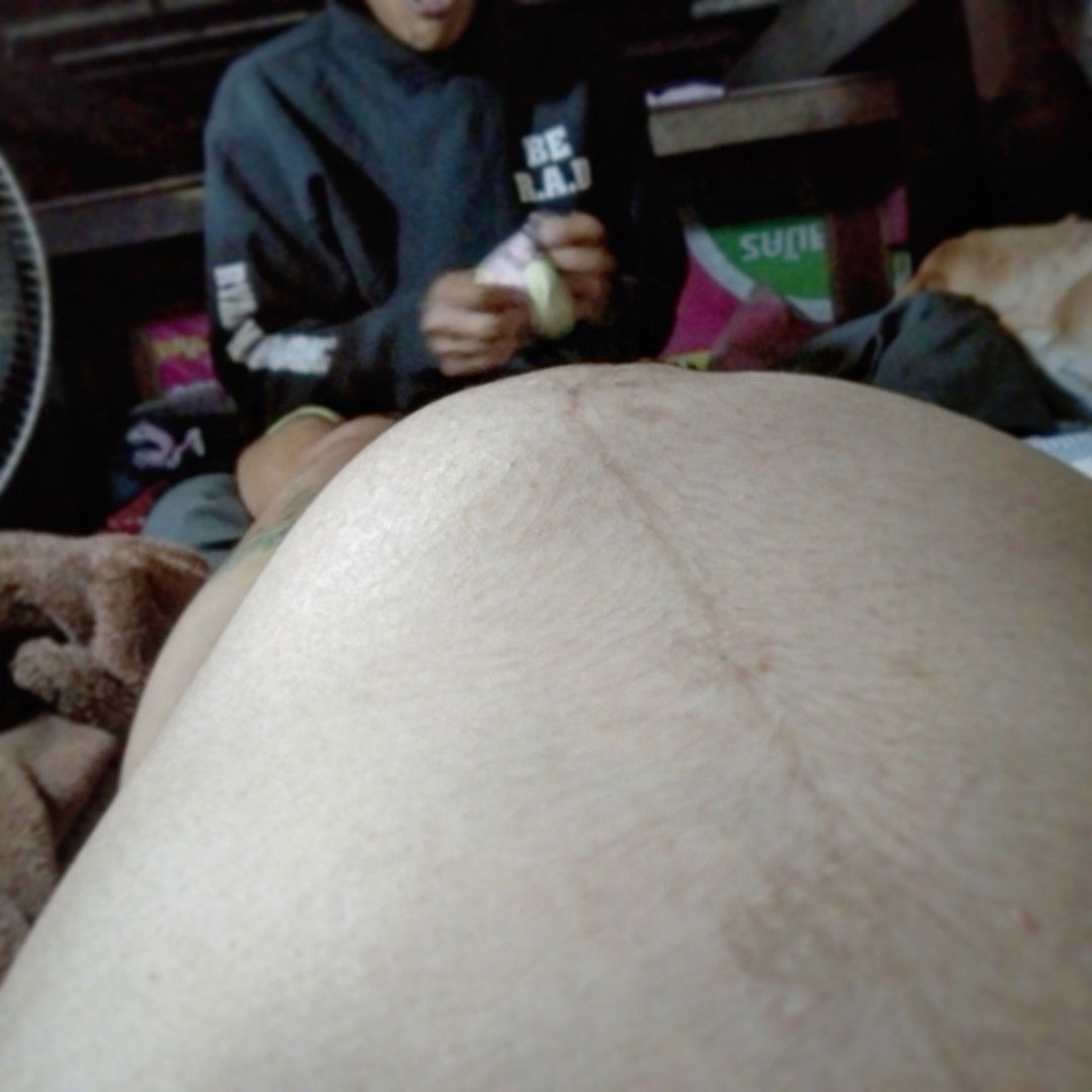 แพ้ท้อง