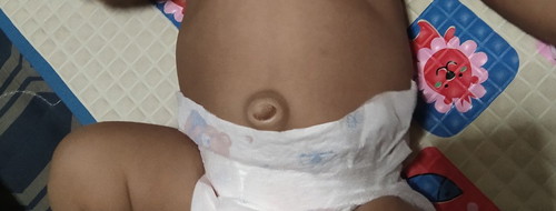 Belly Button Hernia